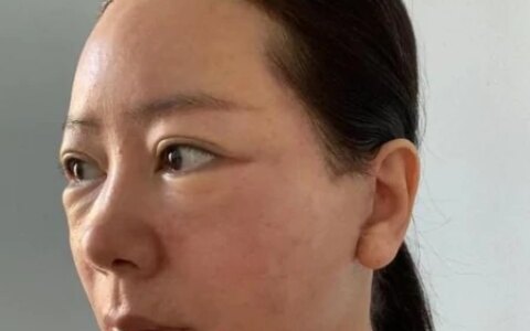 50岁鼓起勇气做拉皮，总结5点教训，句句都是大实话-五十岁女人做脸部拉皮有副作用吗