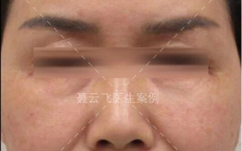 55岁做线雕没效果，来广州做拉皮手术，1周后像变了个人-线雕拉皮视频全过程播放