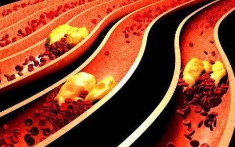 甘油三酯高的人群，少吃两物，坚持两事-甘油三酯高忌吃的食物