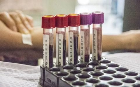 胆固醇和甘油三酯高是病吗？怎么治？医生分享3招轻松降脂-胆固醇和甘油三酯高是什么病