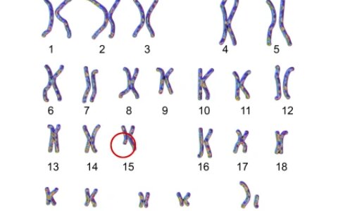 染色体是怎么回事-染色体异常的症状