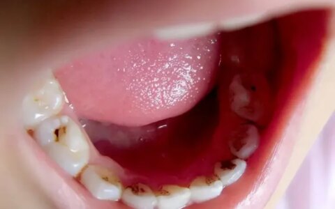 10岁娃用“牙洞修复牙膏”后损失6颗牙，这种智商税可别再交了（补洞牙膏有用吗）