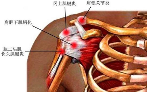 肩膀经常痛？3个动作自测肩周炎，4个拉筋动作告别肩周炎（肩周拉伤怎么治疗锻炼）