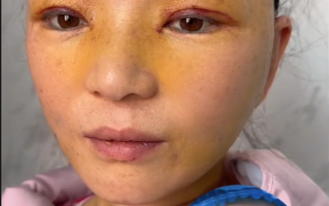 女子花几万做面部拉皮，不到一年就回落？-面部拉皮大概需要多少钱▪