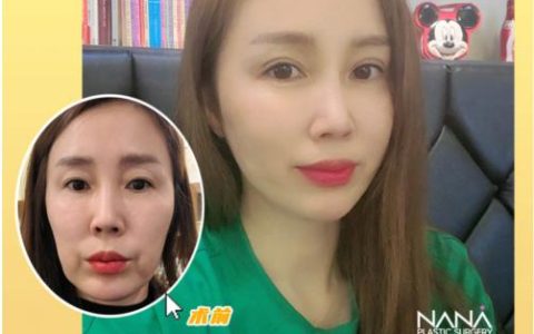 韩国NANA深层拉皮提升，逆转时光，从源头解决问题！-韩国拉皮手术一般多少钱费用