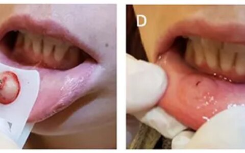 口腔溃疡怎么样才能好的更快？-口腔溃疡怎么能尽快好