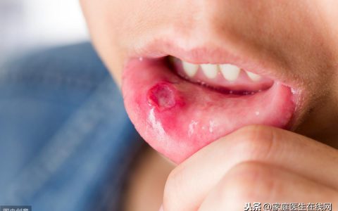 口腔溃疡反反复复？送你4个方法，让它快点“消失”-口腔溃疡反复发作是什么原因,要怎样调治