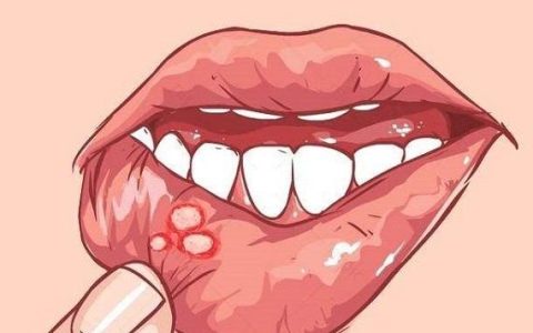 口腔溃疡怎么办？分享一个最快最有效的方法-口腔溃疡应该怎么处理好得快