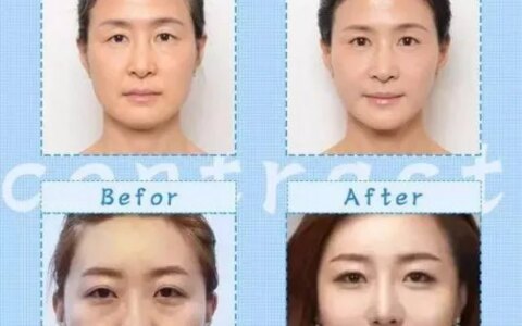 全脸提升什么效果最好？全脸提升多少钱一次？-全脸提升副作用