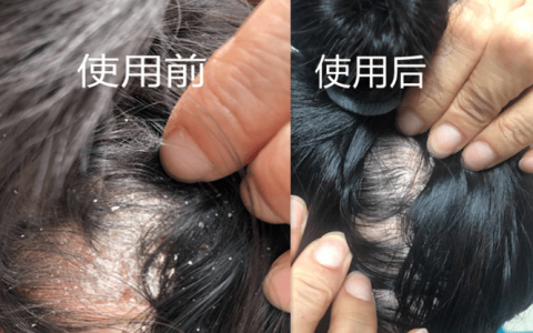 去头屑止痒最好的洗发水是哪个牌子?【头屑零打扰】-去头屑洗发水什么牌子好