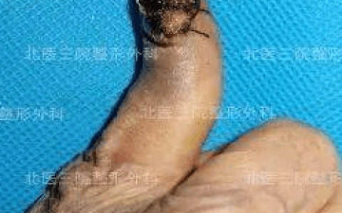 因为甲沟炎就被截掉了手指?-甲沟炎剪断了梗在里面