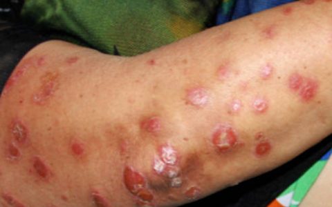 长沙治疗皮肤病医院哪家好？长沙市皮肤医院排名-长沙鸿业皮肤病专科医院-长沙中研皮肤病医院