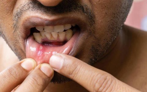 原创
缓解口腔溃疡的有效方法，你知道吗？-迅速缓解口腔溃疡