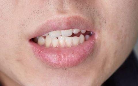 原创
拔智齿后牙齿真的会变松吗？什么样的智齿必须拔？一次性说清楚-拔了智齿牙齿会变整齐吗