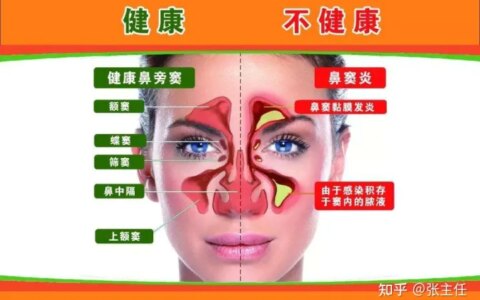 鼻窦炎怎么治疗能够根除？从医50年余年老中医教你这这样做，鼻窦炎远离你！（治疗鼻窦炎的13个偏方）