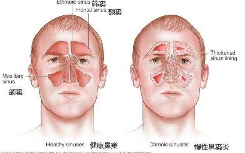 鼻塞你以为是鼻炎了？其实还有可能是鼻窦炎，4招改善鼻窦炎烦恼（鼻塞是鼻窦炎的症状吗）