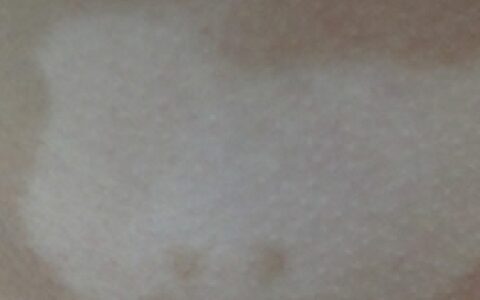 背部得白癜风该怎样治疗好（肩胛骨有白色点）