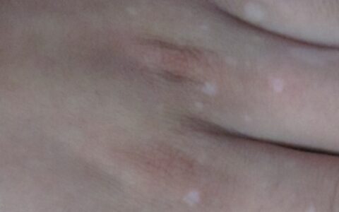 孩子白癜风该怎样治疗好