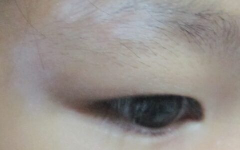 该怎样治疗好患得白癜风（怎么治好肝癌）