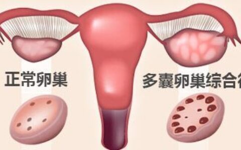 多囊卵巢综合征怎样治疗好的快（多囊卵巢综合症最好的治疗方法）