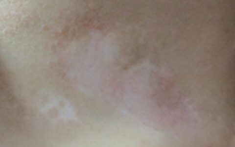 儿童得了白癜风怎样治疗好（小孩白点癫风早期图片）