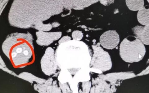 吃完杨梅，肠胃里竟出现密密麻麻小点？医生紧急提醒，千万别这么吃（每吃一颗杨梅就等于吞了六个活蛆）