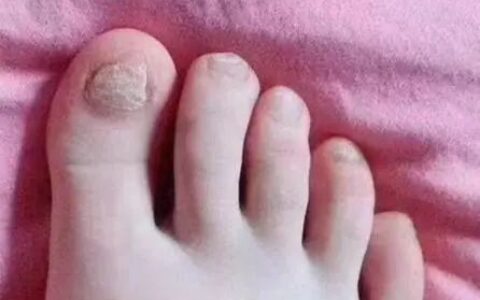 灰指甲最有效的药治疗费用！在家就能清除灰指甲！你一定要试试看！-治灰指甲最好的药是什么药?