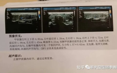 中医解读甲状腺结节、甲亢、甲减，弄懂这些，治疗起来事半功倍-中医对甲状腺结节的治疗效果