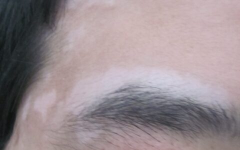 该如何治疗男性的白癜风（男性怎么治）