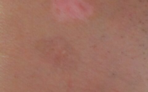 该如何治疗男性患的白癜风（男性怎样治）