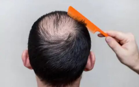 非那雄胺喷雾剂，已完成全球首例应用，男性雄激素脱发治疗新希望（非那雄胺喷涂治疗脱发用法）