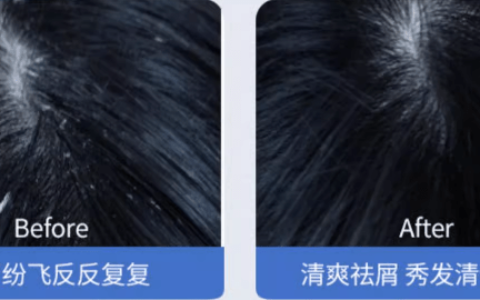 头痒头屑脱发严重怎样治疗|?分享好用止痒！（头痒皮屑多脱发怎么办）