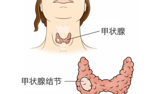 甲状腺结节4类需要手术吗？南昌贡方堂：中医治疗调理有办法！-甲状腺结节4类要手术吗