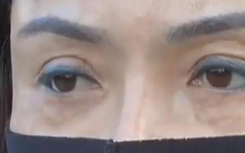 花15500做面部提拉，女子术后只能戴口罩示人，医师回应令人愤恨-面部提升带