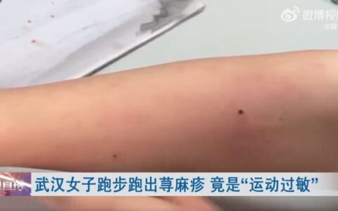 女子跑步过敏！长荨麻疹-女子跑步过敏怎么办