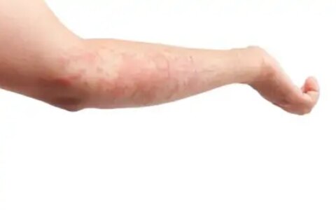 以前不过敏，为何突然开始过敏了？过敏不遗传，遗传的是它-以前不过敏,现在变过敏体质