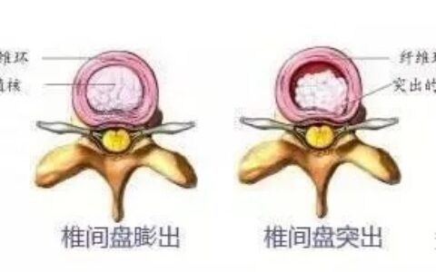 腰椎间盘突出症的治疗方法（完整版）-腰椎间盘突出症的治疗方式