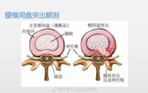一起了解腰椎间盘突出症的康复治疗-腰椎间盘突出症的康复治疗方案