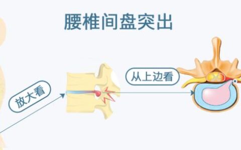 体医科普｜腰椎间盘比业绩更突出？五种锻炼方法有助缓解-腰椎间盘突出该怎么锻炼效果较佳