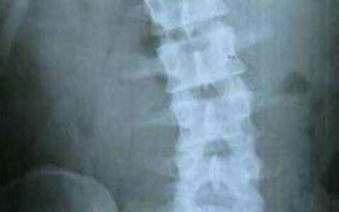 腰椎间盘突出的治疗-腰椎间盘突出症状和视频讲解