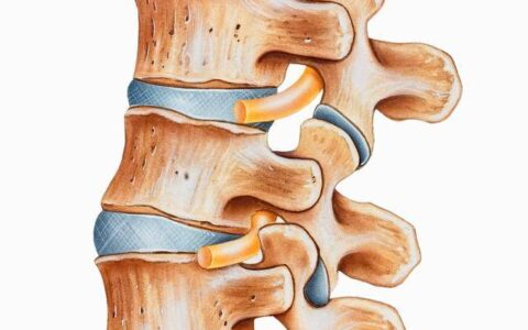 中域教育张氏正骨|手术治疗VS保守治疗 （腰椎间盘突出）