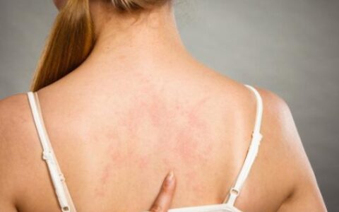 荨麻疹有靠谱的偏方吗？夏天患荨麻疹、湿疹、汗疱疹该怎么办？-荨麻疹最快的偏方大全