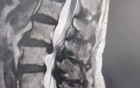 多科联合手术，成功治疗严重腰椎间盘突出症-多节腰椎间盘突出手术