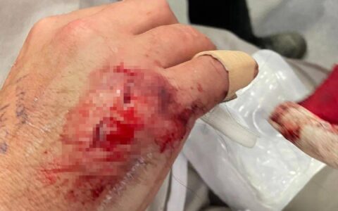 新西兰华人爆料：老公出门遭恶犬无故撕咬，鲜血淋漓！至今找不到狗和主人……