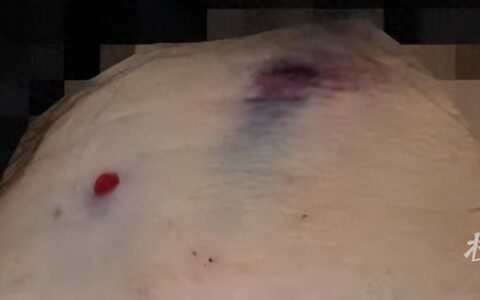 先是额头被五步蛇咬，再是后腰被蜱虫叮，临安王大姐为了这最鲜的一口差点丧命……