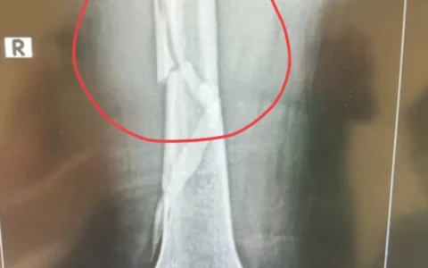 向太大腿骨断裂！手术5小时，术后举动更吓坏医生！