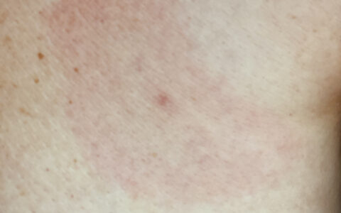 春季过敏大作战：你的皮肤，我来守护！